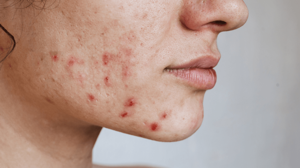 Unlock Clear Acne Free Skin