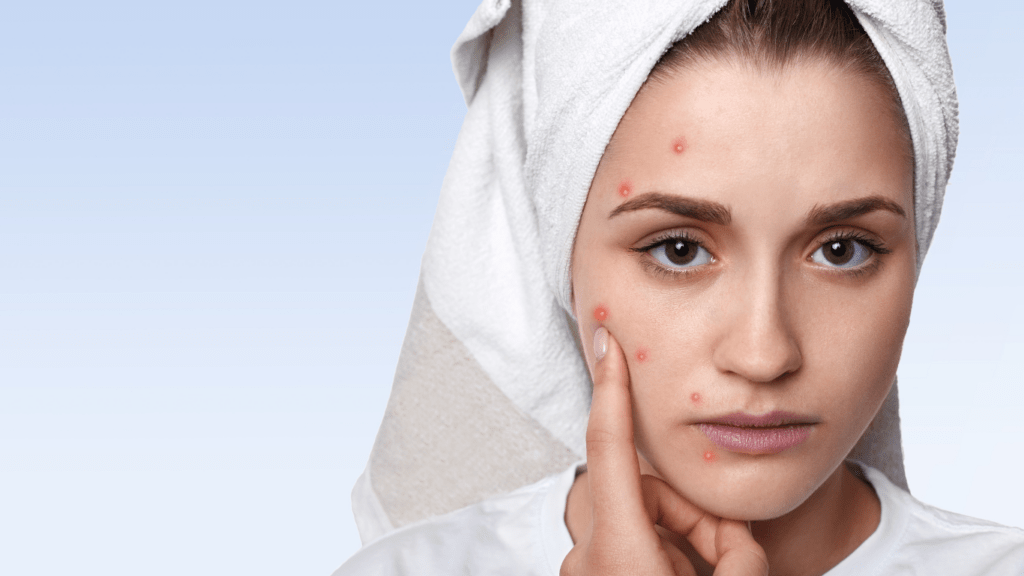 a close up of a person with acne on their face