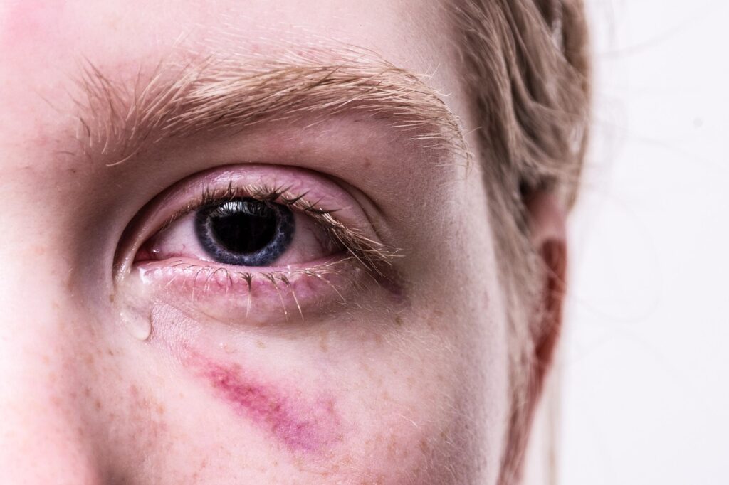 trauma, injured, tear, traumatized, pain, injury, cry, hematoma, tormented, suffering, eye, bruise, problem, tears, girl