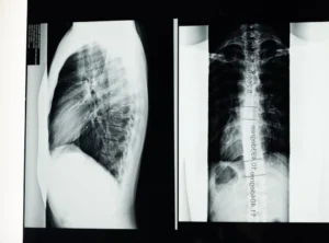 Why Gerenaldoposis Disease Is Bad