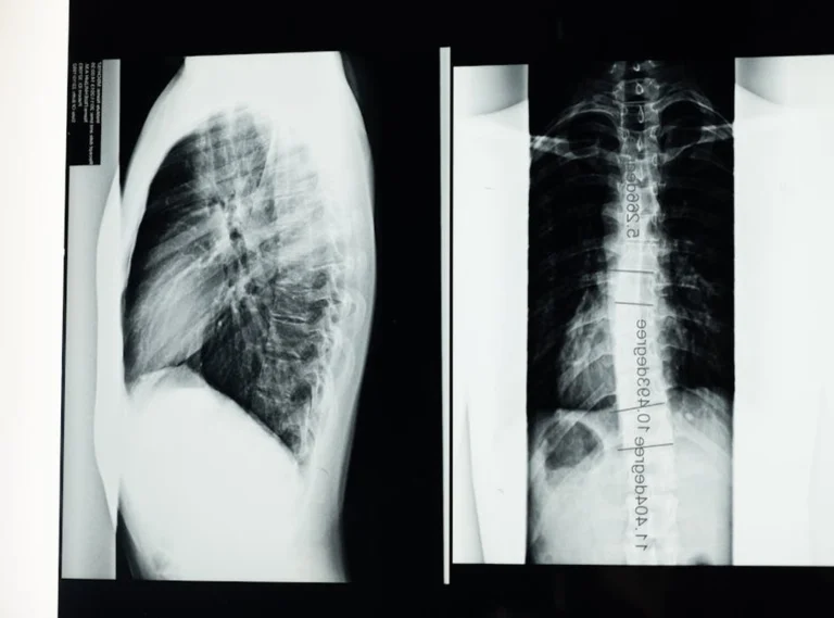 Why Gerenaldoposis Disease Is Bad